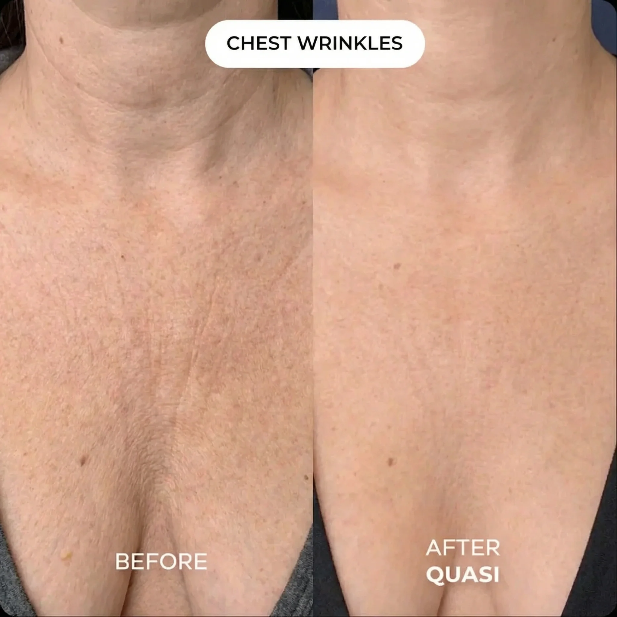 Collagen Chest Mask (free gift) - Image 4