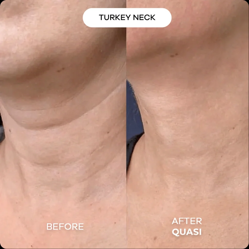 Collagen Neck Mask (free gift) - Image 4